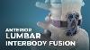 What Is Anterior Lumbar Interbody Fusion Alif Atlanticspinecenter
